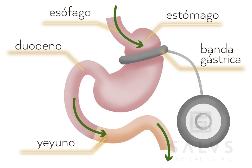 Banda gástrica en Granada Clínica Salus