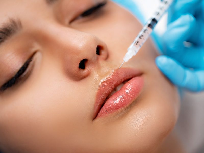 ¿Cuánto dura el ácido hialurónico en los labios?