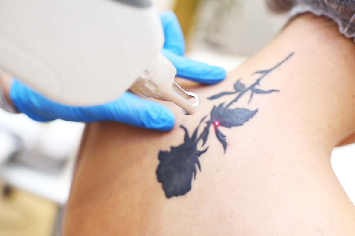 Todo lo que necesitas saber sobre borrar tatuajes