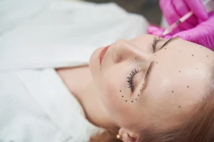 Mujer antes de una blefaroplastia con laser plexr