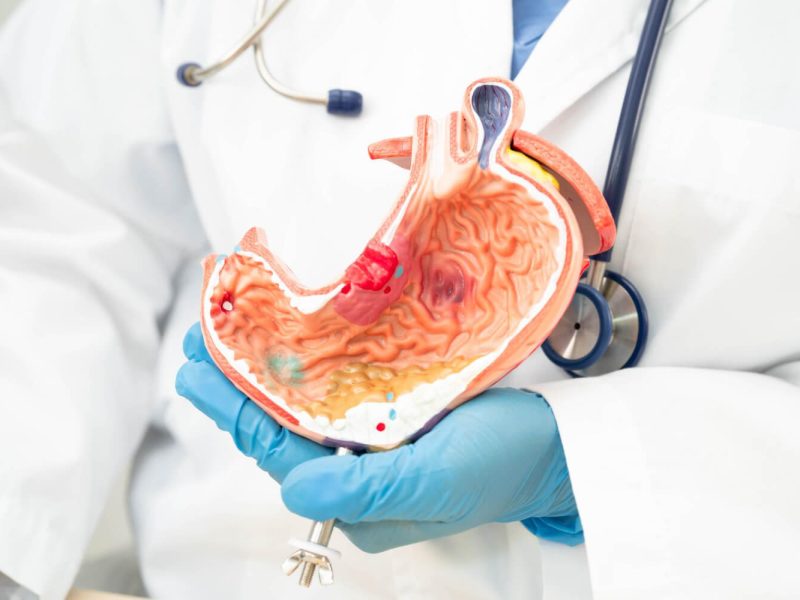 ventajas y desventajas balon gastrico