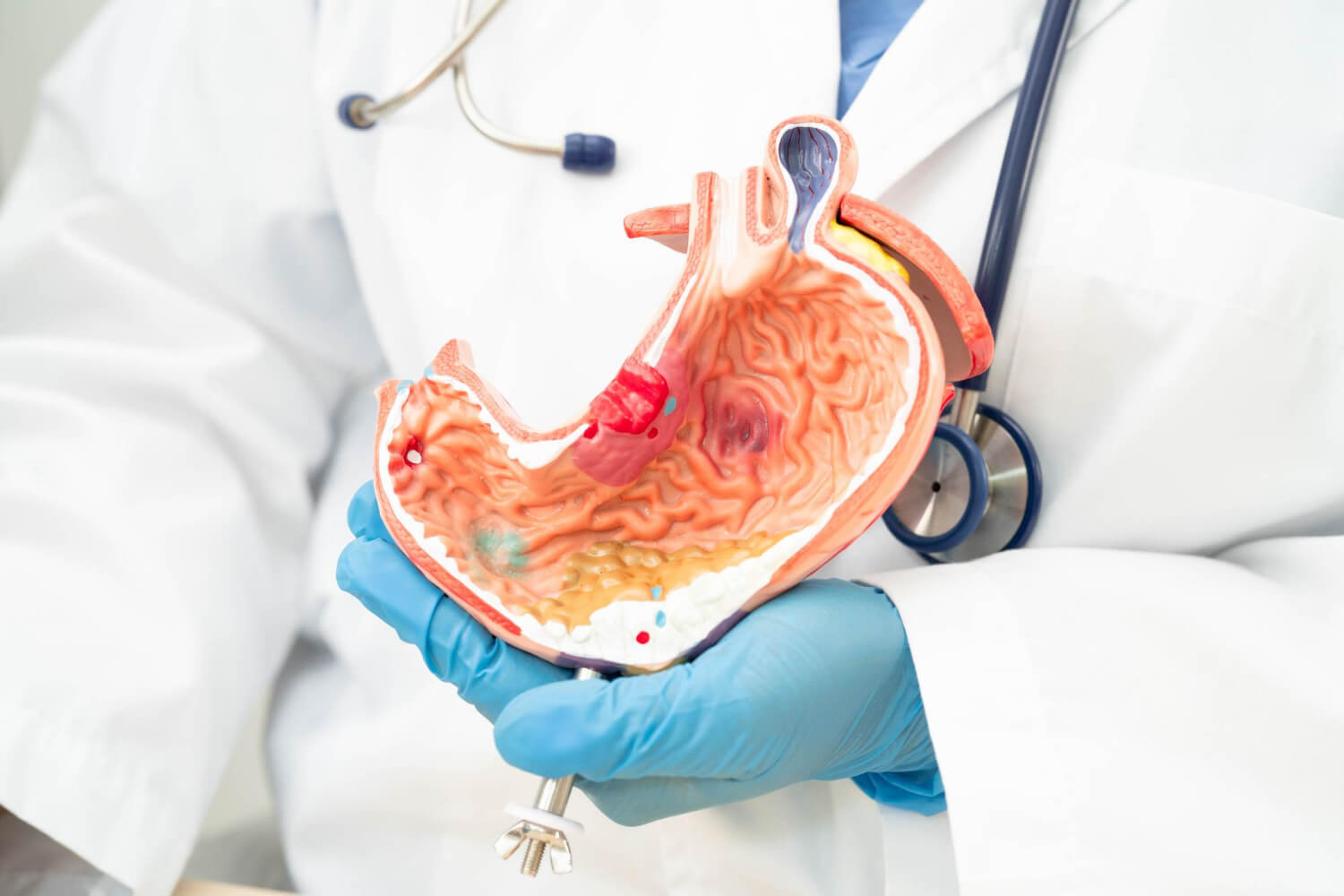 ventajas y desventajas balon gastrico