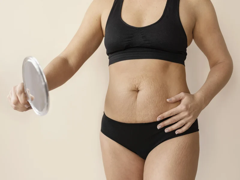 Mujer con estrías mirándose a un espejo.
