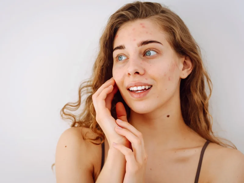 Mujer con manchas en la piel.