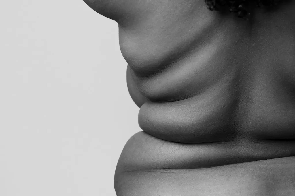 Abdomen con obesidad antes del tratamiento con dieta y bypass gástrico