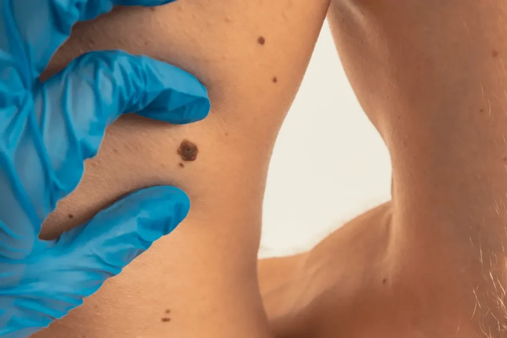 revision de verrugas por parte de un medico
